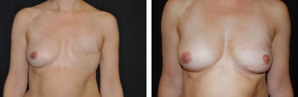 Kvinna 42 år, Bröstrekonstruktion