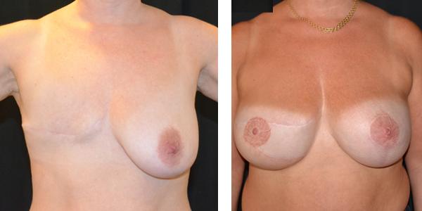 Kvinna 48 år, Bröstrekonstruktion