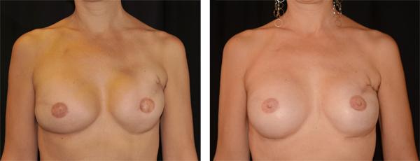 Kvinna 45 år, Bröstrekonstruktion