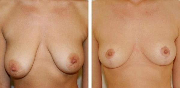 Kvinna 29 år, Bröstförminskning och bröstlyft