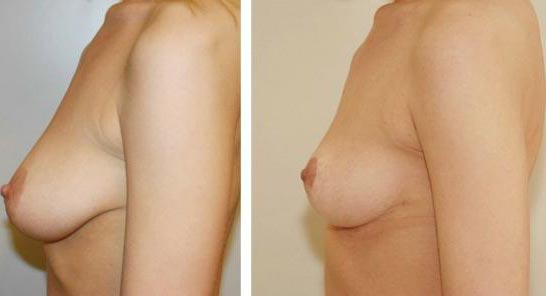 Kvinna 29 år, Bröstförminskning och bröstlyft