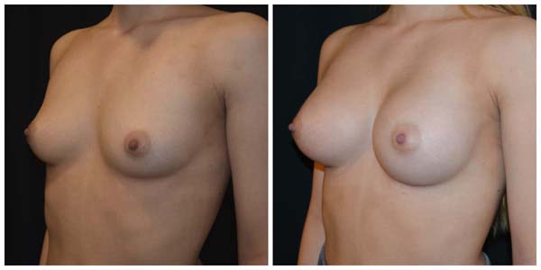 Kvinna 24 år, Bröstförstoring anatomiska implantat