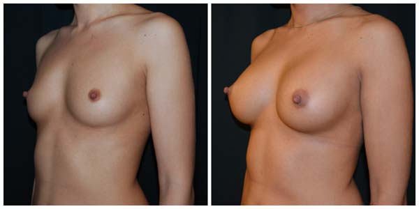 Kvinna 25 år, Bröstförstoring anatomiska implantat