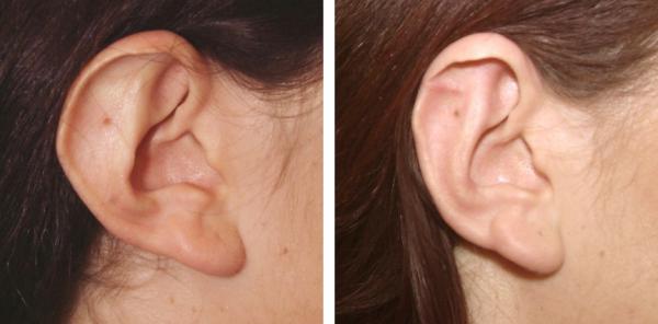 Kvinna 33 år, Utåtstående öron